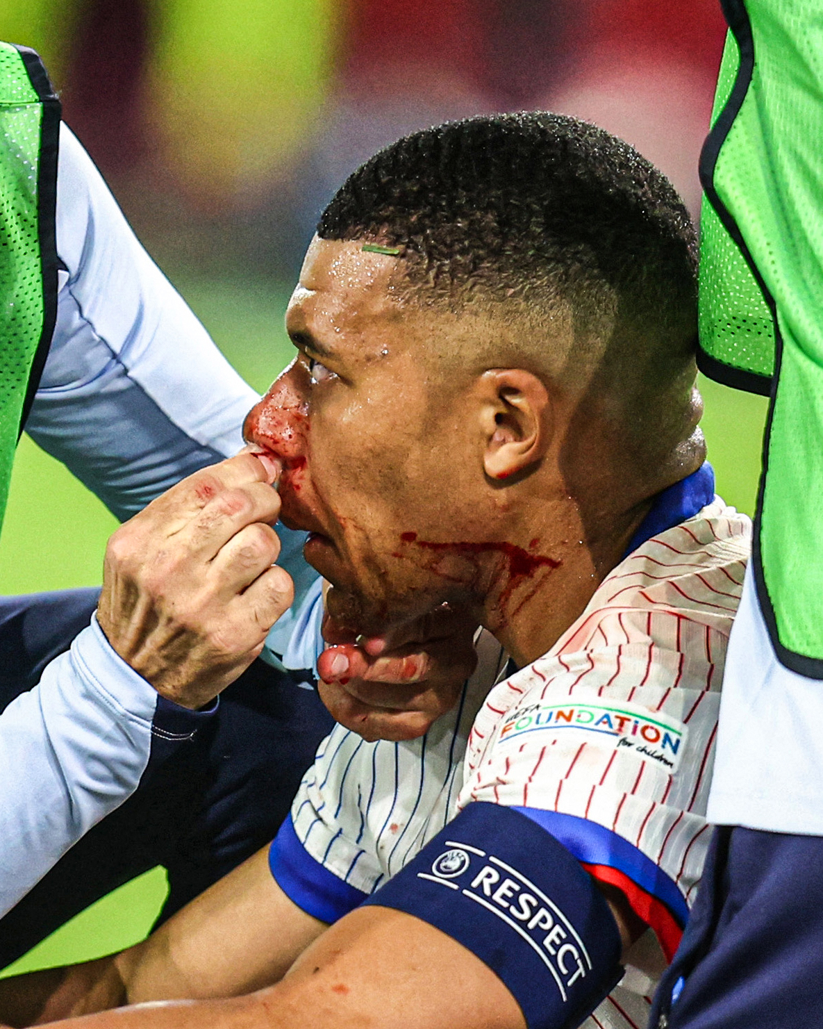 Kylian Mbappe is treated for broken nose. (X)
